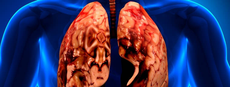 Lung damages award guidelines leap 79% in NI jurisdiction