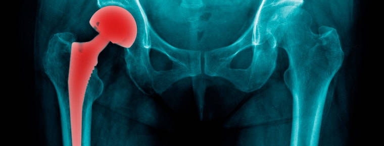 Vulnerable victims of faulty hip replacements are short-changed in settlements