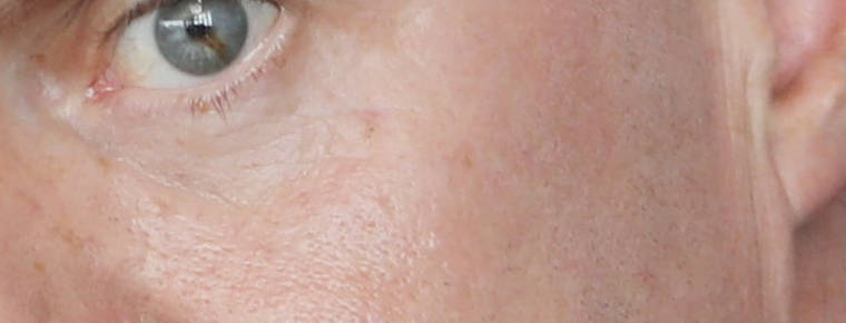 85% of litigated injury claims settled for under 100k